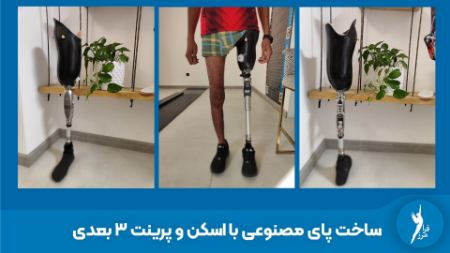 ساخت پای مصنوعی در کلینیک ارتوپدی فنی فرامرز