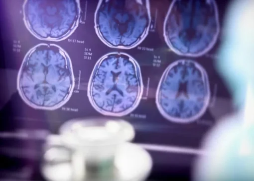 هوش مصنوعی با یک اسکن به تشخیص 9 نوع زوال عقل با دقت 88 درصدی کمک می‌کند